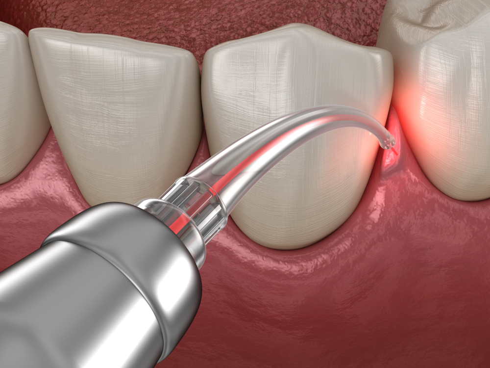 The Benefits of LANAP® Laser Gum Surgery
