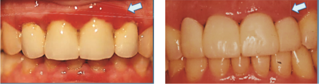 LANAP treatment before and after photos