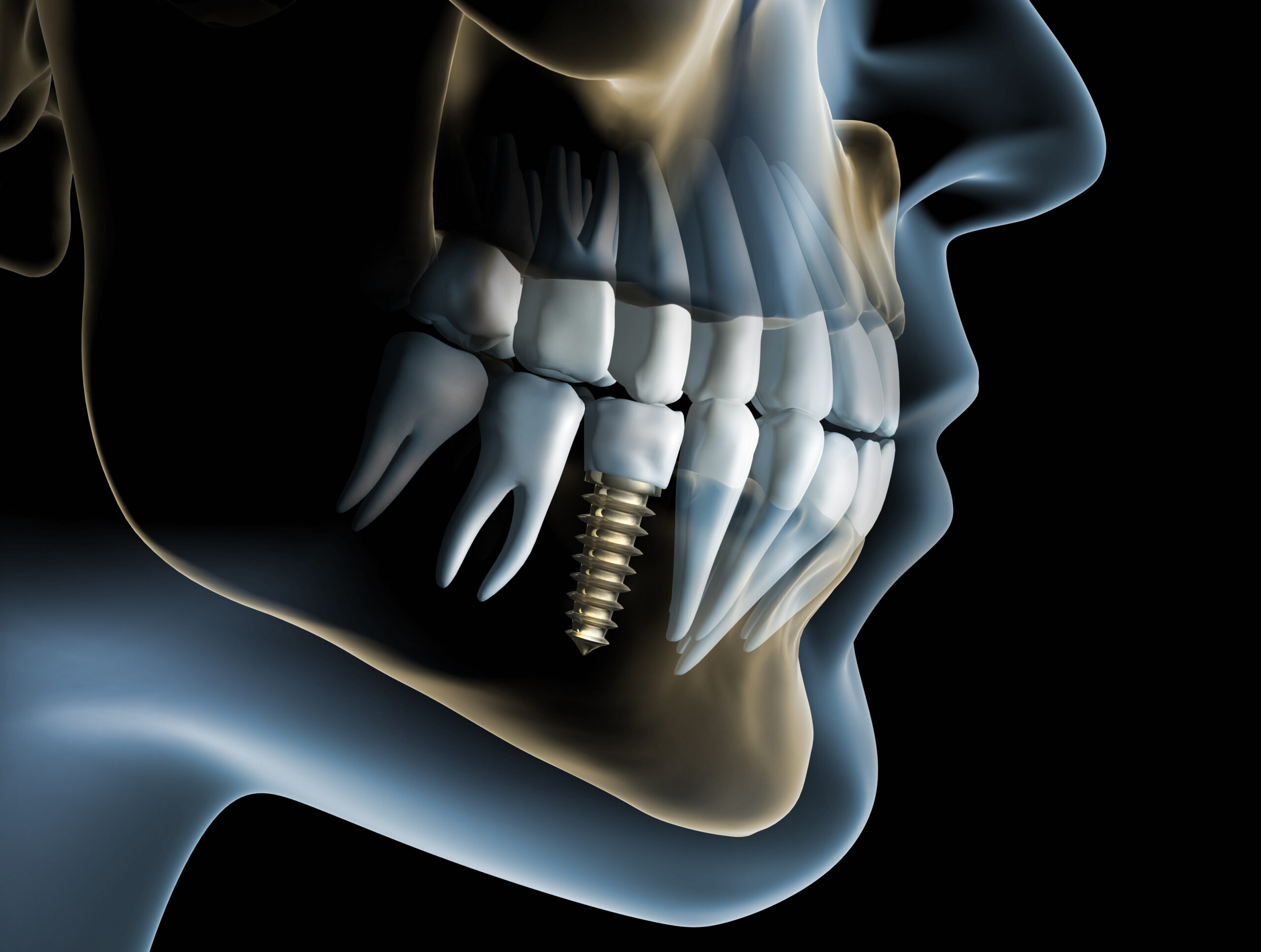 Dental Implants with Periodontal Disease