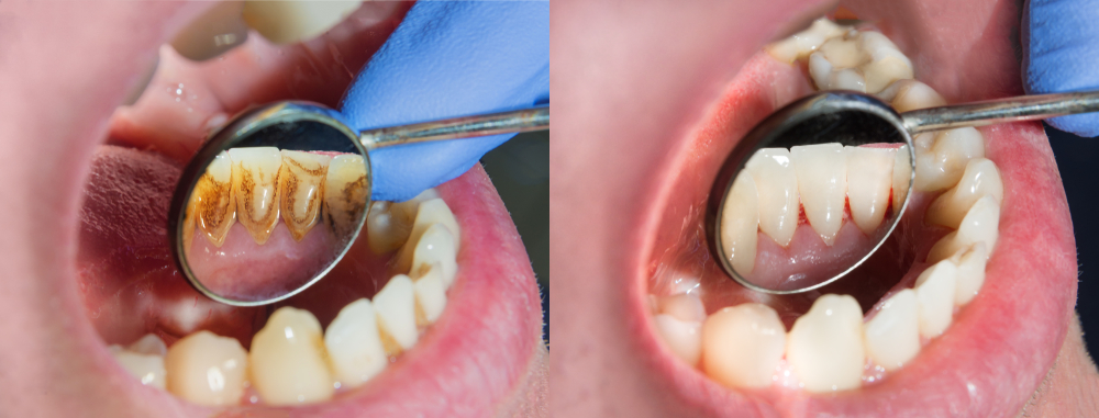 periodontal disease