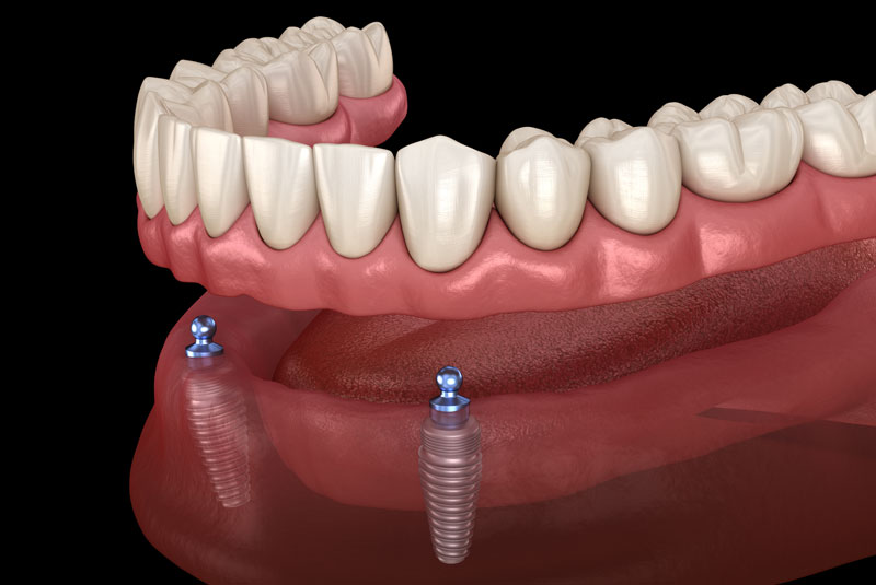 implant supported denture model.