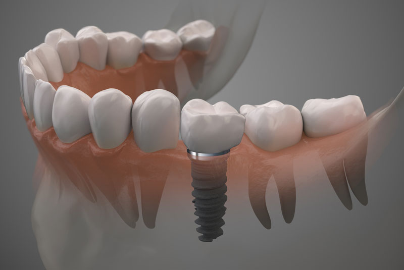 Dental Implant Graphic