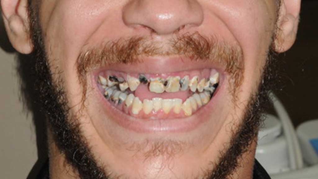 TeethToday® Dental Implants Fort Lauderdale, FL