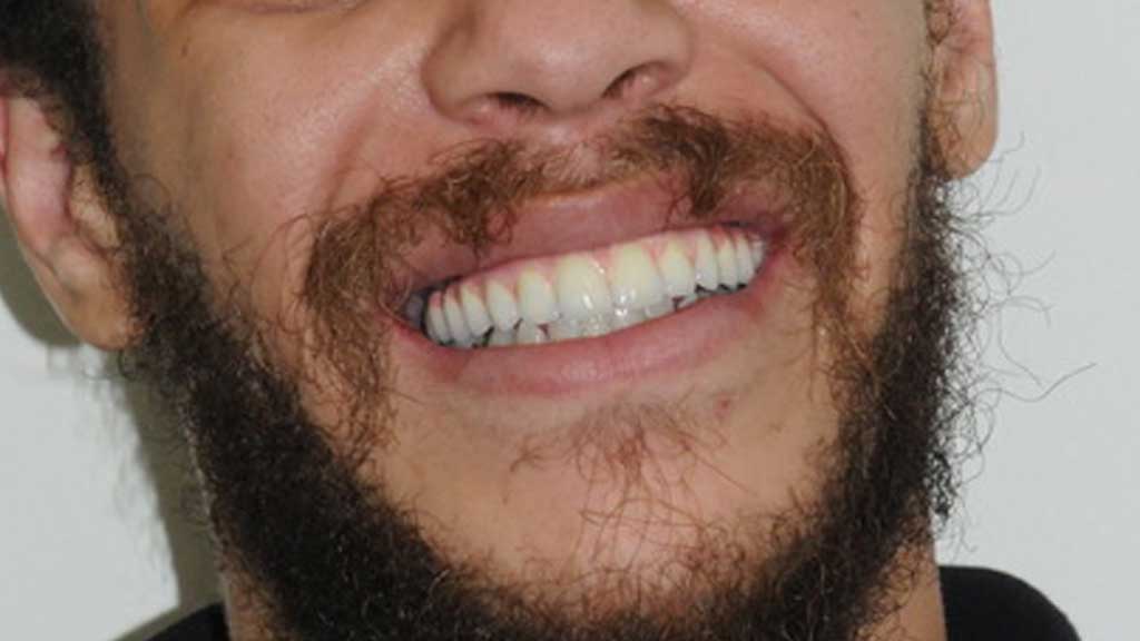 TeethToday® Dental Implants Fort Lauderdale, FL