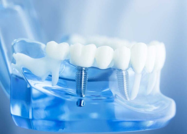 model of a placed dental implant