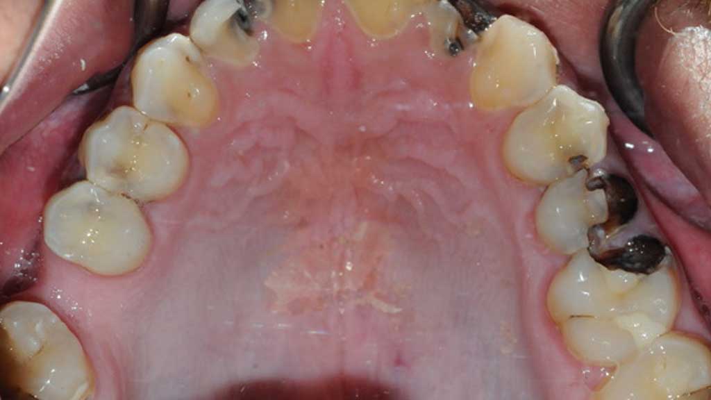 TeethToday® Dental Implants Fort Lauderdale, FL
