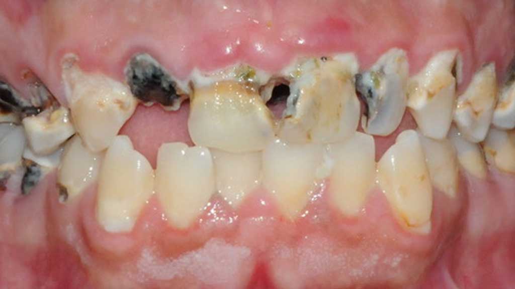 TeethToday® Dental Implants Fort Lauderdale, FL
