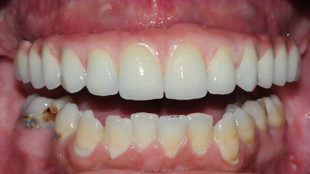TeethToday® Dental Implants Fort Lauderdale, FL