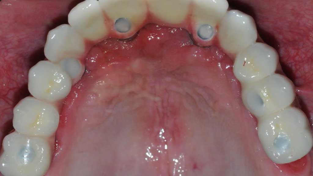TeethToday® Dental Implants Fort Lauderdale, FL