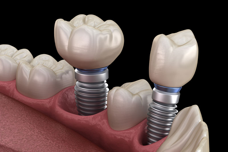 How A Dental Implant Looks In Your Mouth