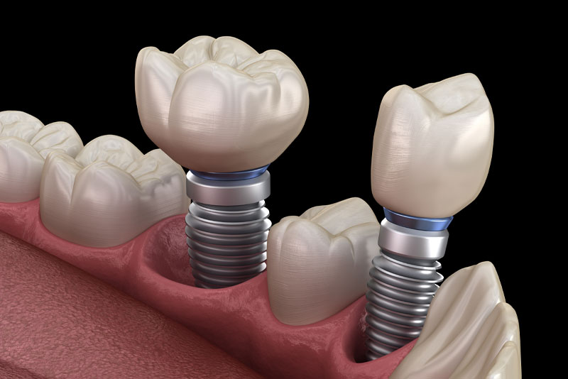 How A Dental Implant Looks In Your Mouth