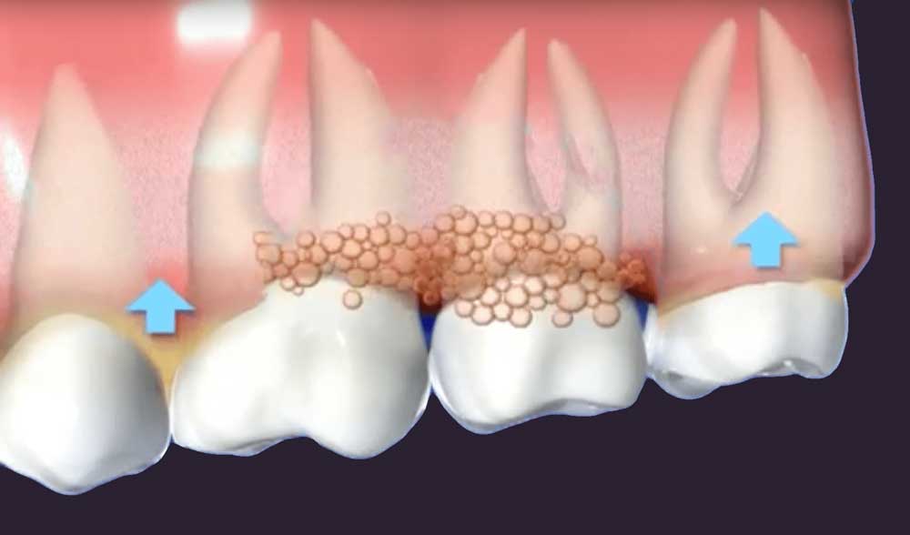 a diagram depicting gums affected by gum disease