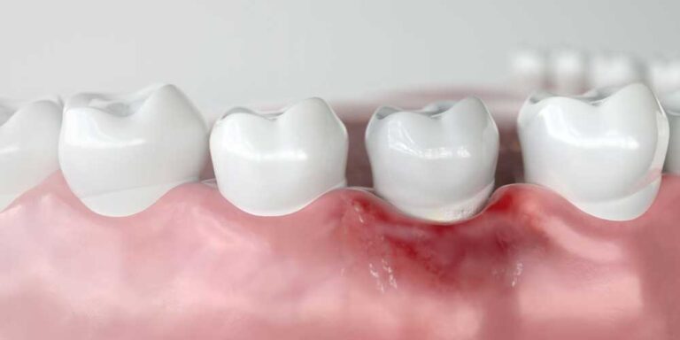 a model portraying receding gums