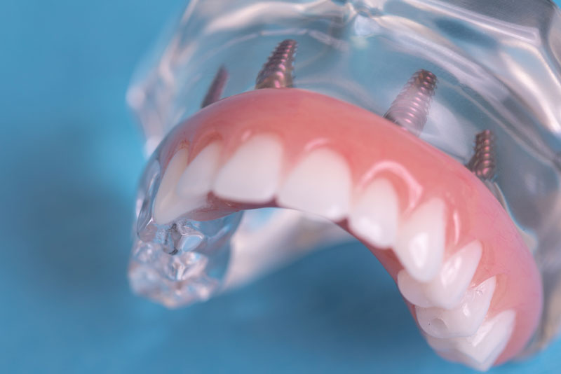 Full Arch Dental Implant Model