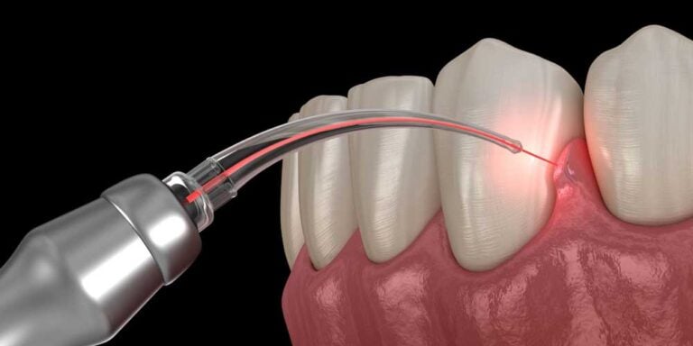 LANAP Gum Disease Treatment