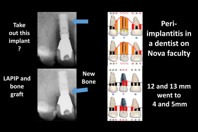 LAPIP® LASER PERI-IMPLANTITIS TREATMENT - FORT LAUDERDALE, FL