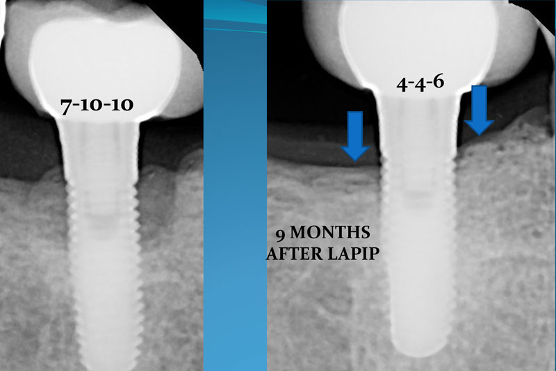 LAPIP® LASER PERI-IMPLANTITIS TREATMENT - FORT LAUDERDALE, FL