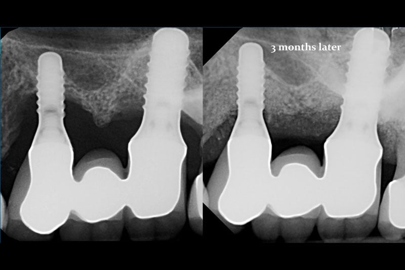 LAPIP® LASER PERI-IMPLANTITIS TREATMENT - FORT LAUDERDALE, FL