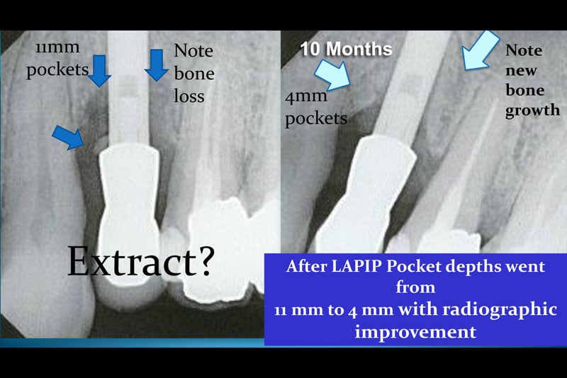 LAPIP® LASER PERI-IMPLANTITIS TREATMENT - FORT LAUDERDALE, FL