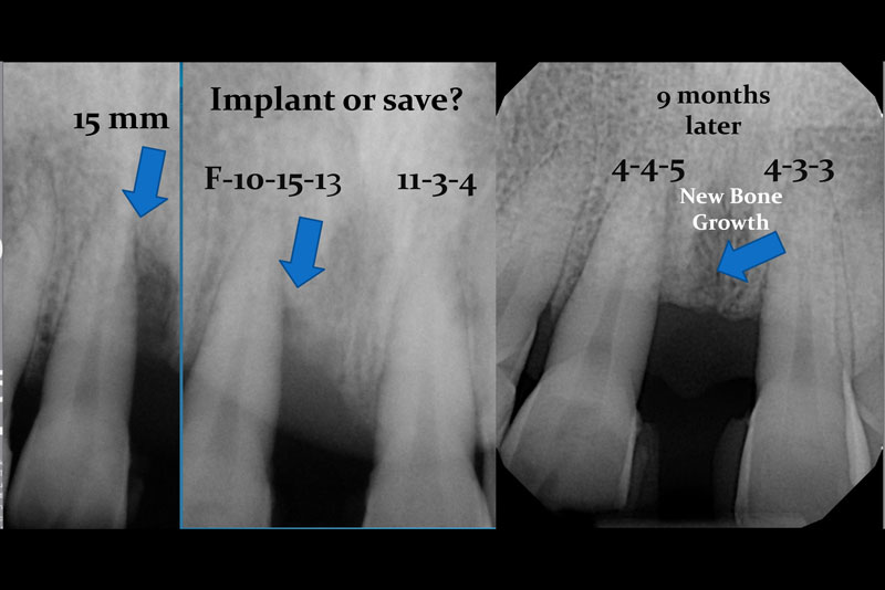 LASER DENTISTRY - FORT LAUDERDALE, FL