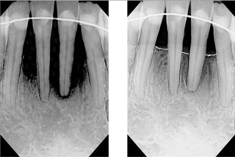 LASER DENTISTRY - FORT LAUDERDALE, FL