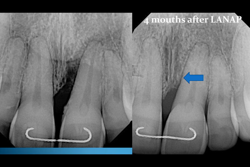 LASER DENTISTRY - FORT LAUDERDALE, FL