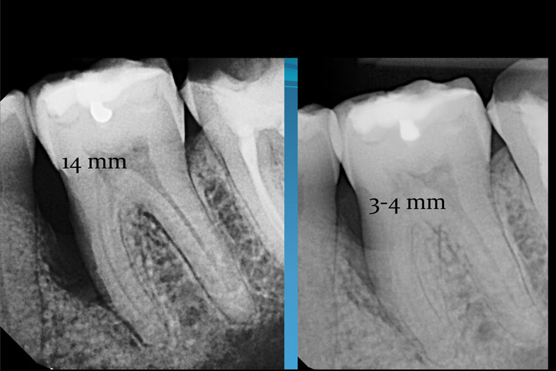 LASER DENTISTRY - FORT LAUDERDALE, FL