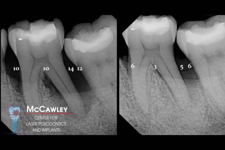 LASER DENTISTRY - FORT LAUDERDALE, FL