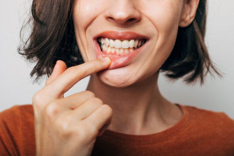 a dental patient showing her receding gums before treatment.