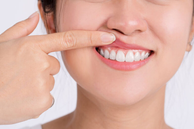 An image of a dental patient showing their gums.