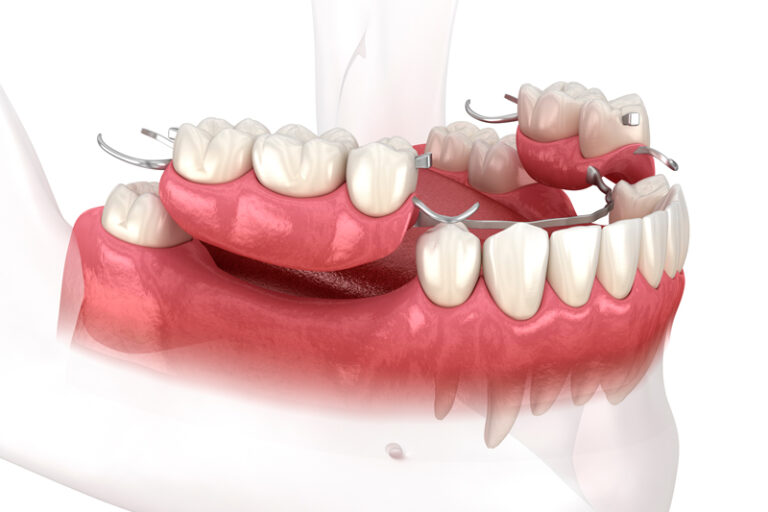 Close-up 3d image of a dental pick taking plaque off teeth