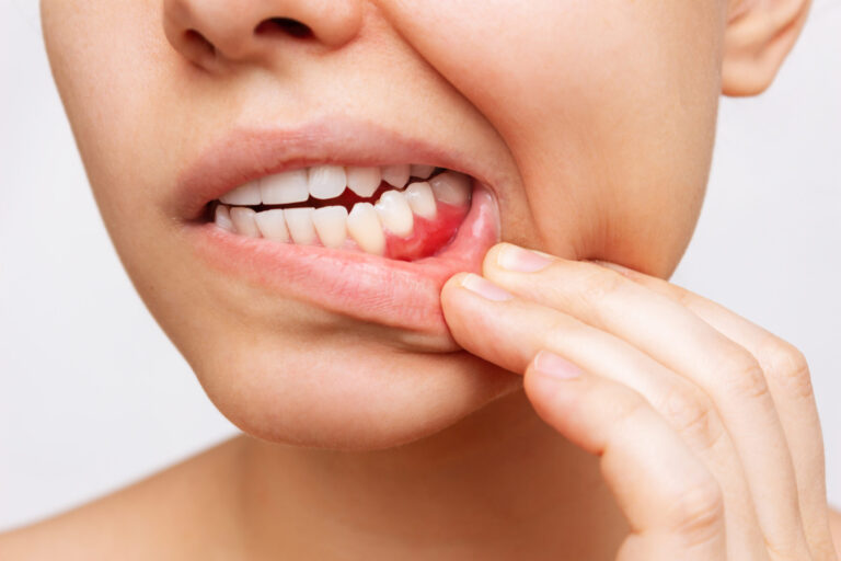 an image of a dental patient in need of periodontal treatment.