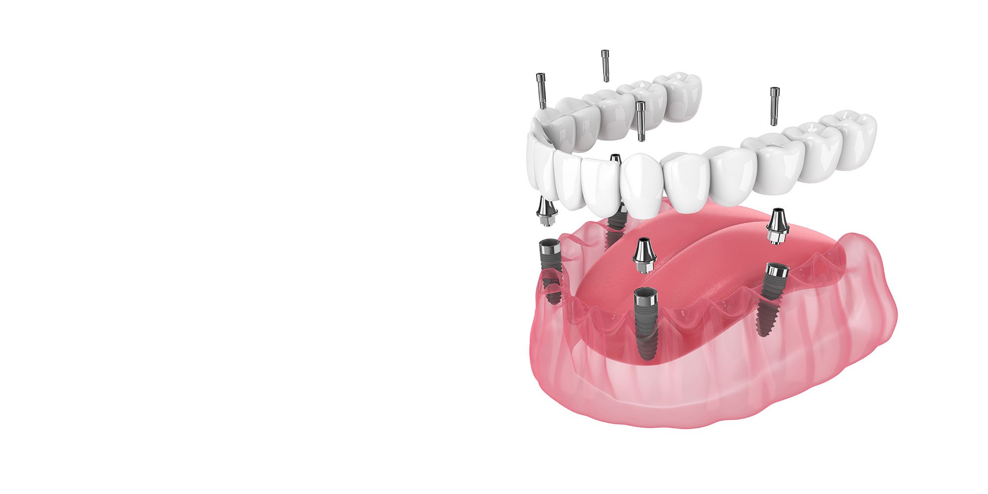 all on 4 dental implants