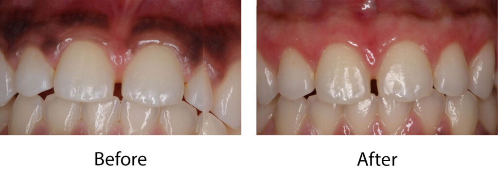 Laser Depigmentation