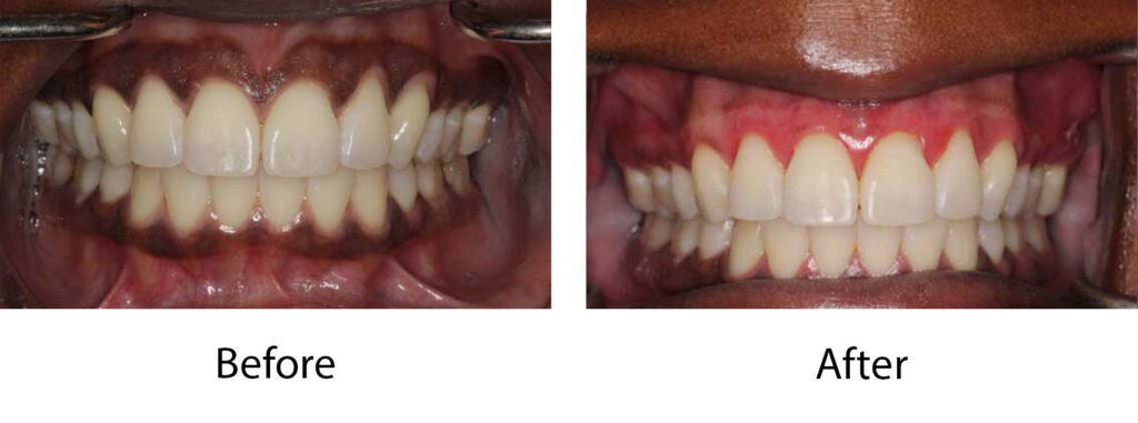 Laser Depigmentation Case 2