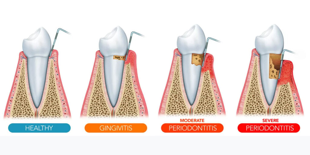 gum disease graphic