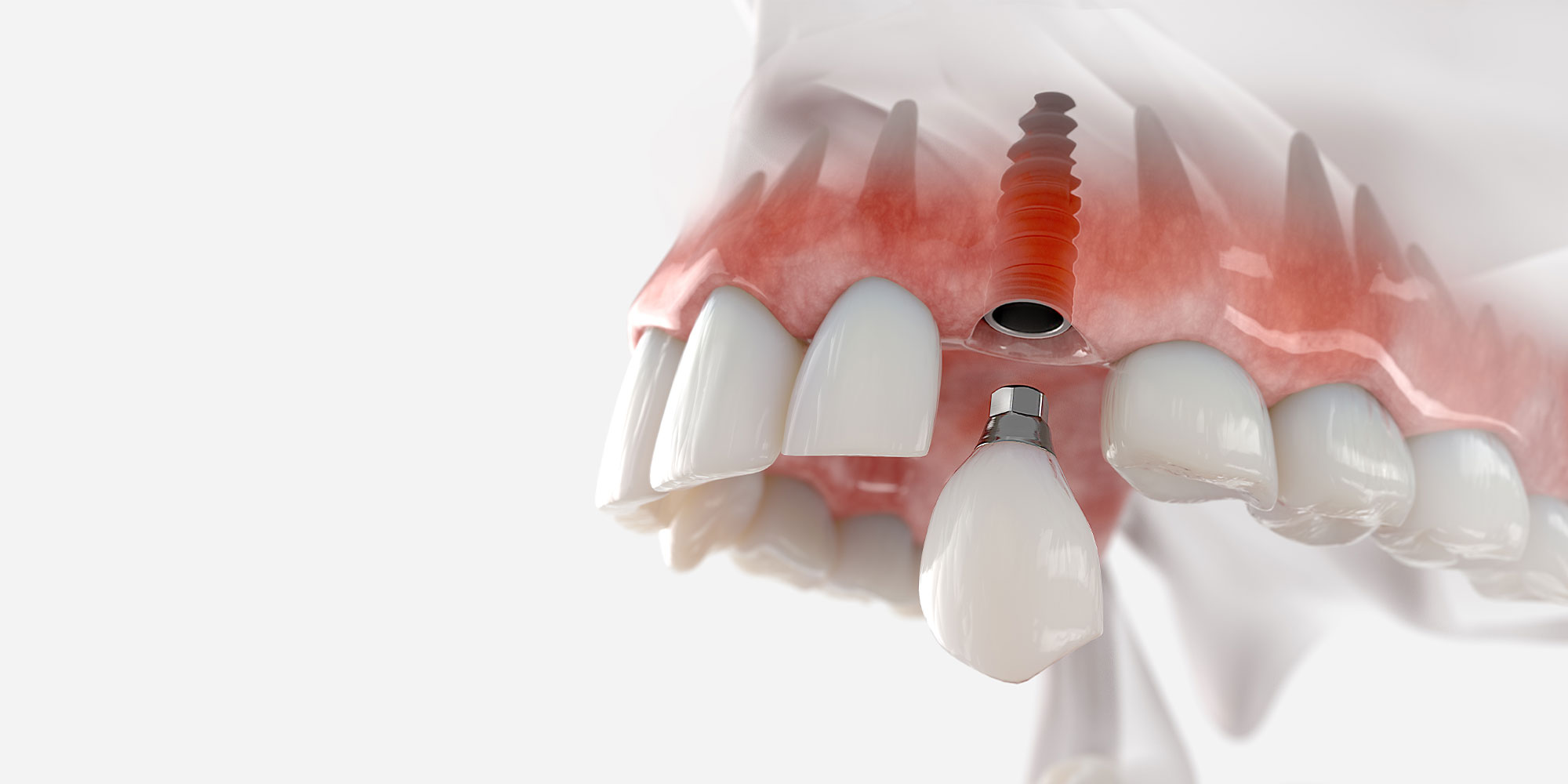 dental implant 3d grpahic