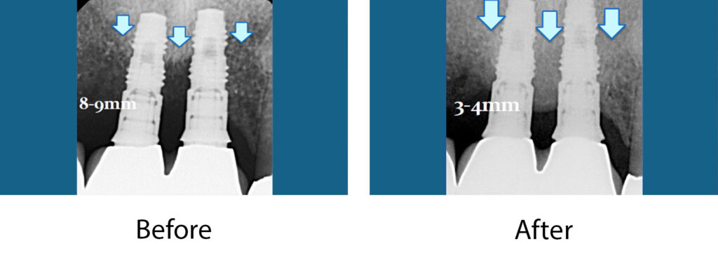 LAPIP Case 2