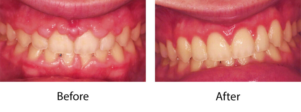 Laser Crown Lengthening Case 2