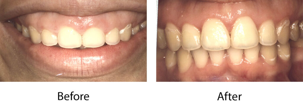 Laser Clinical Crown Lengthening Case 1