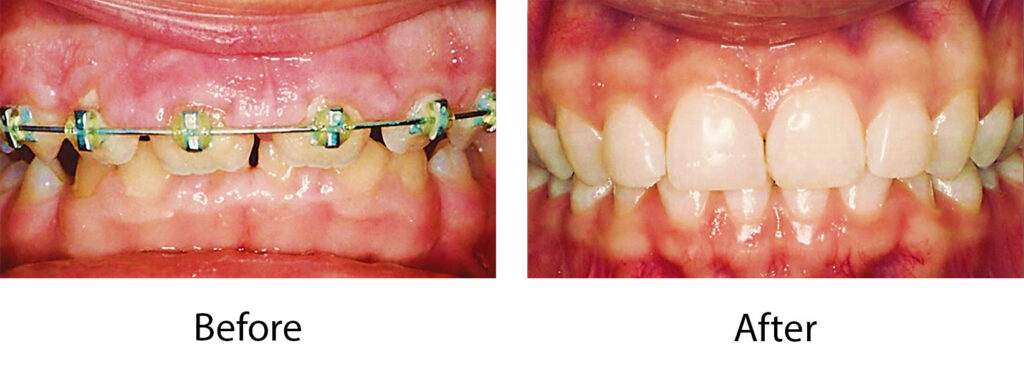 Laser Crown Lengthening Case 3