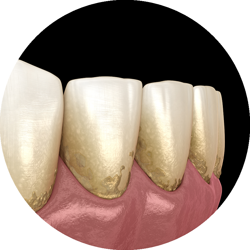 periodontal disease