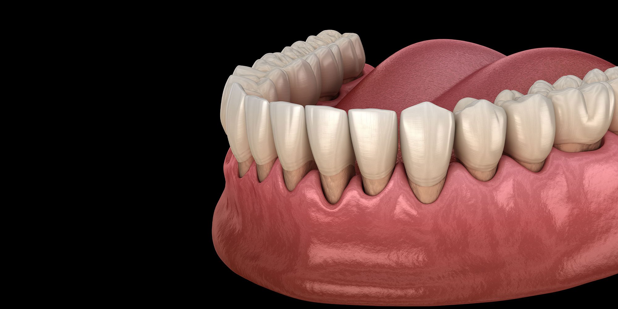 gum recession 3d graphic