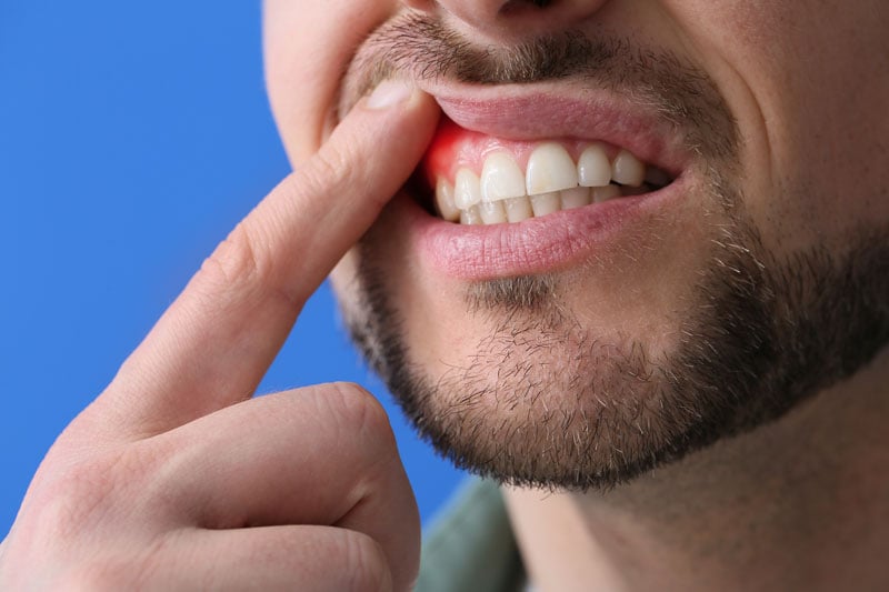 man with gum inflammation.