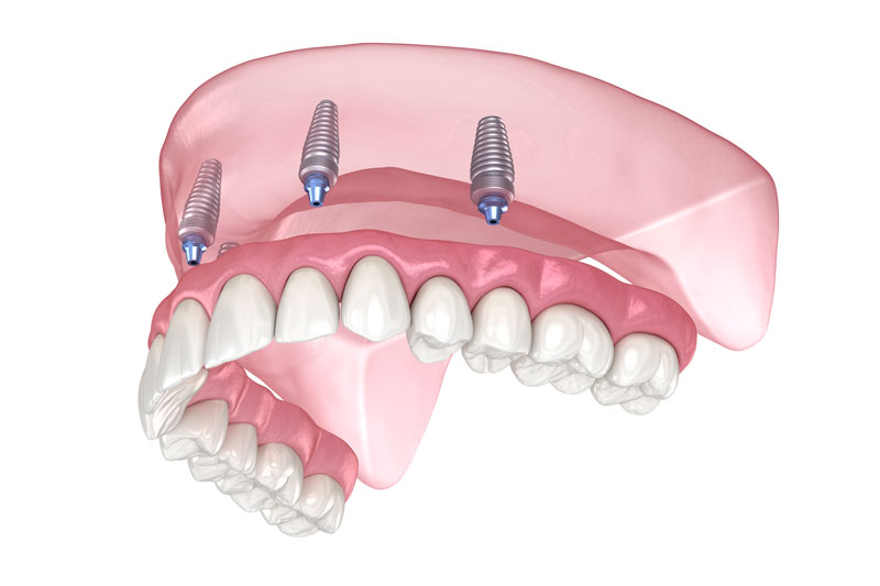 all-on-4 dental implants.