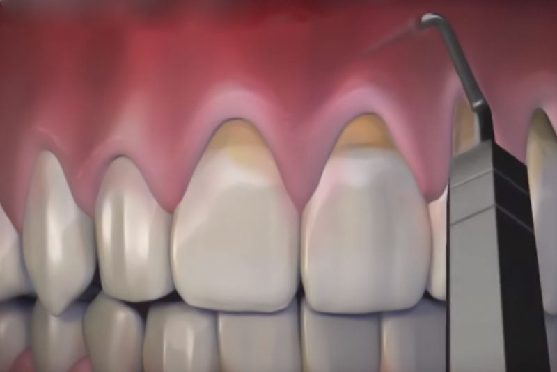 pinhole surgical technique.