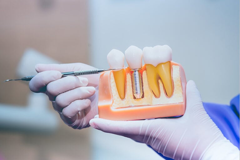 4 Types of Dental Implants: Which One Is Right for You?