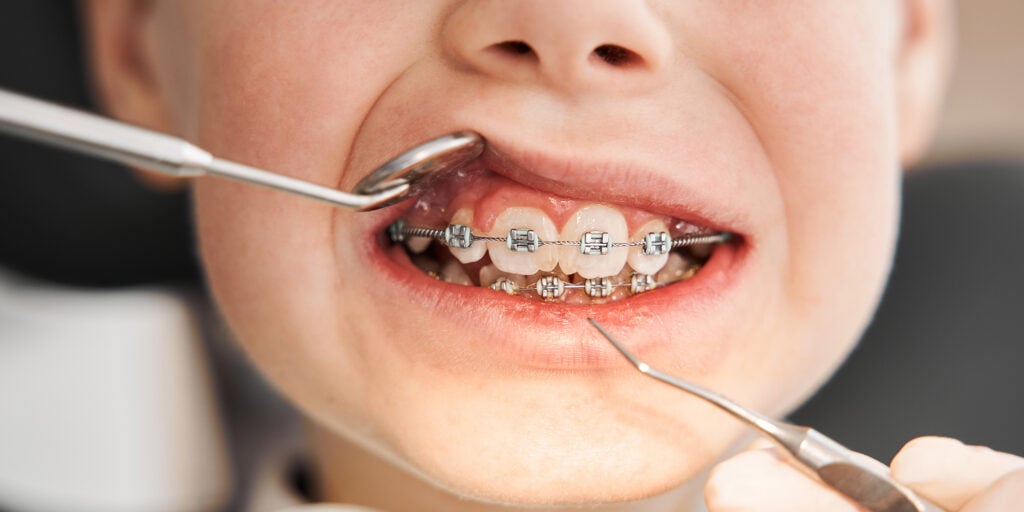 Protecting Gum and Bone Health During Orthodontic Treatment