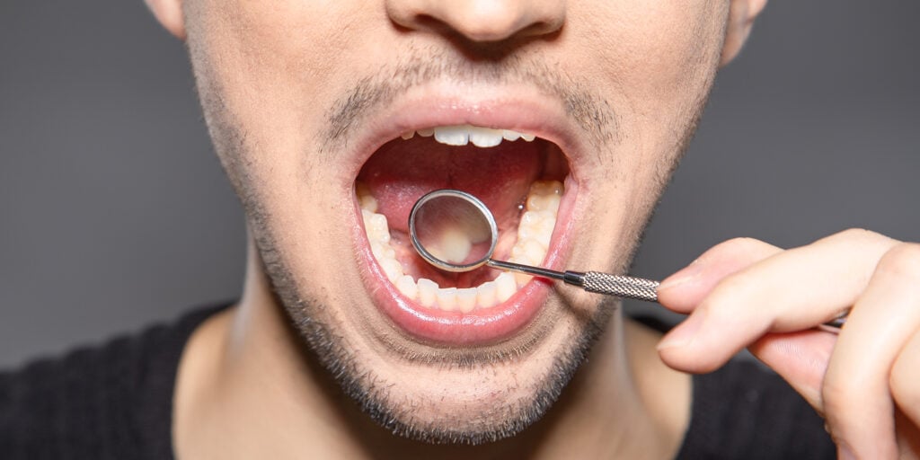 Can Dry Mouth Cause Periodontal Disease?