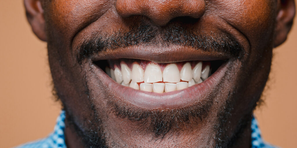 Receding Gums? Discover a Gentler Way to Restore Your Smile